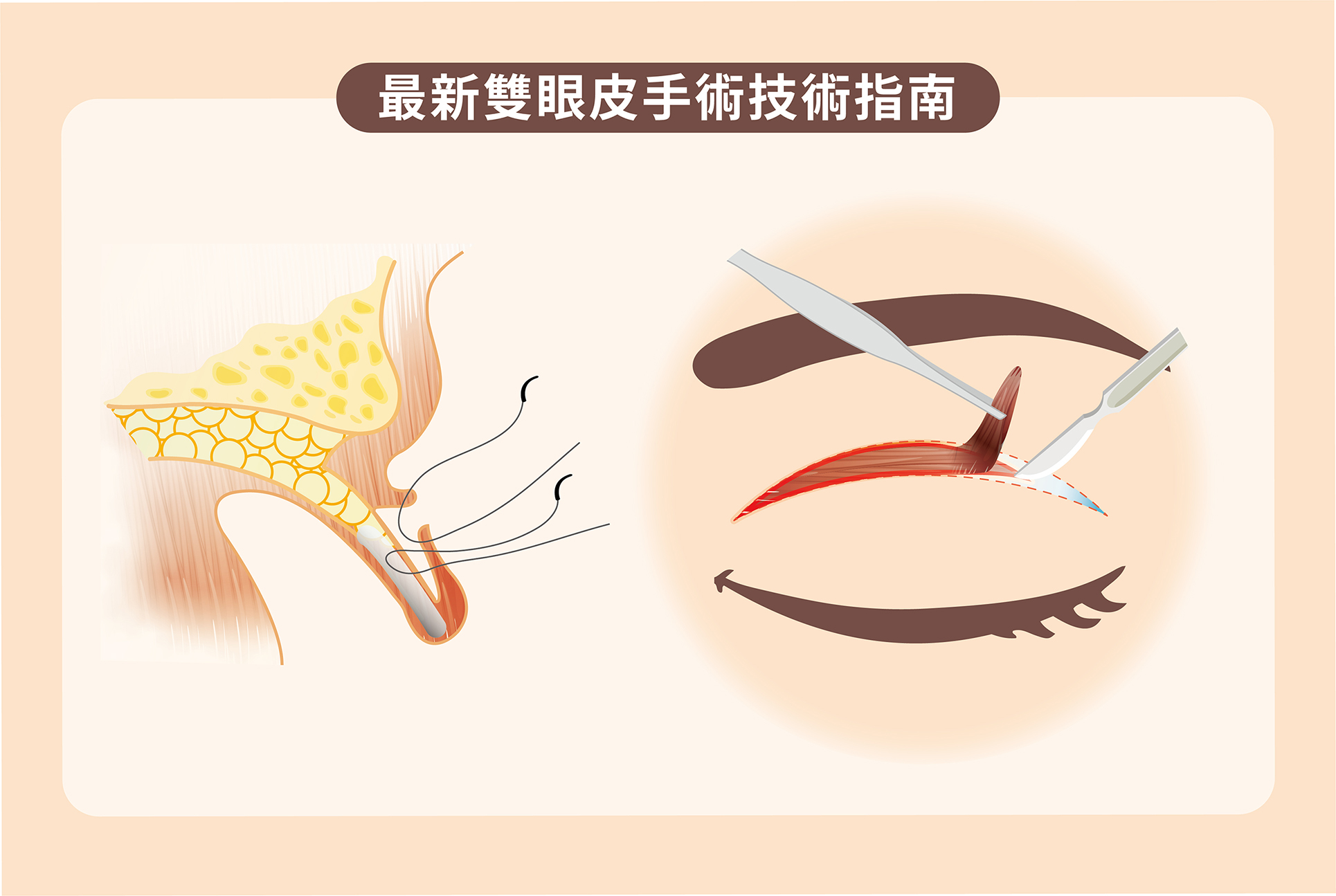 2025年雙眼皮手術技術指南