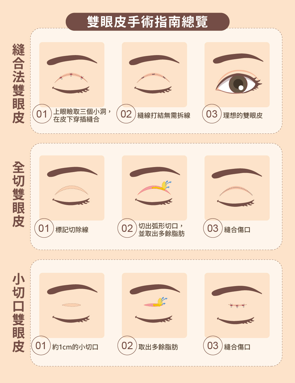 2025台灣雙眼皮手術完整指南