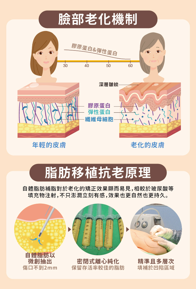 臉部老化機制與自體脂肪移植原理圖 - 顯示脂肪流失過程與補脂治療