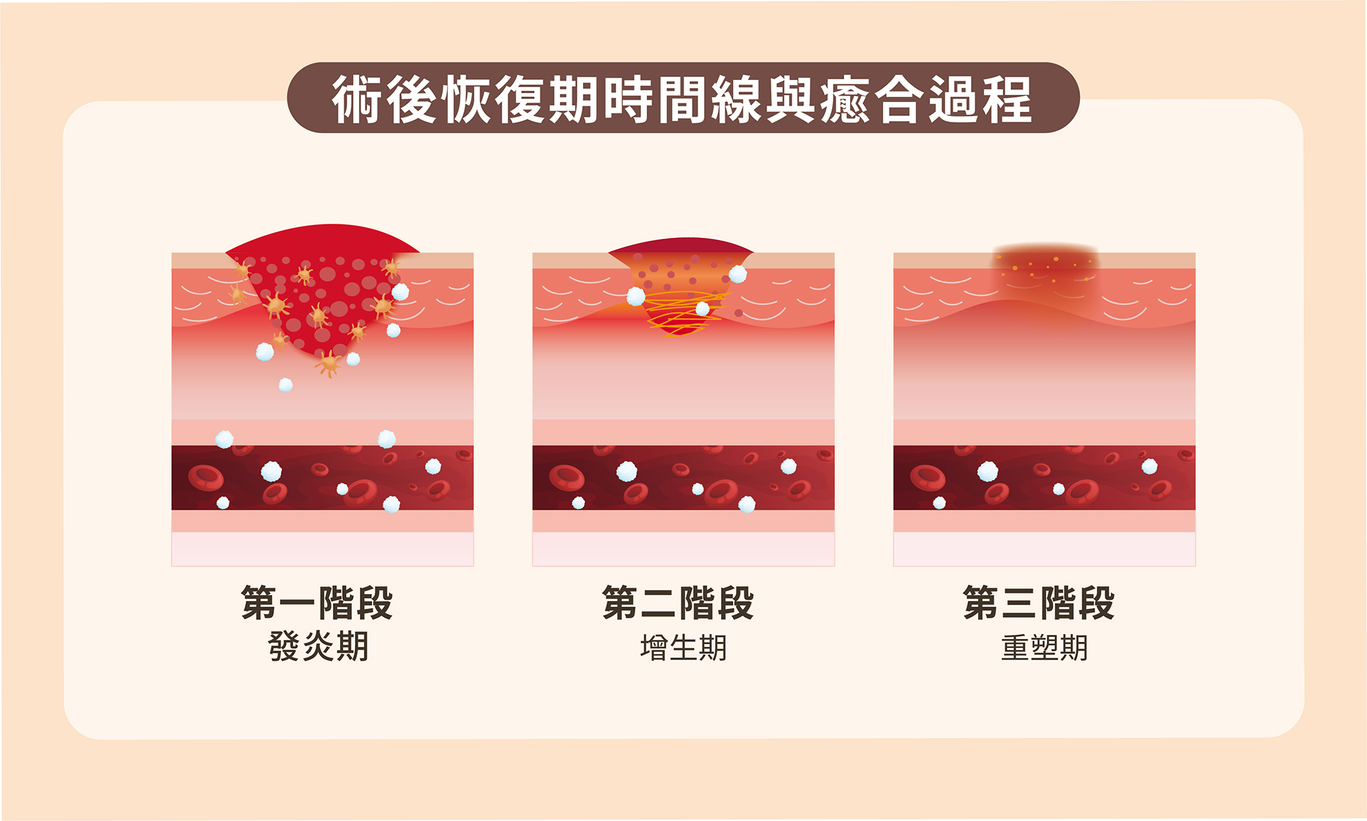 術後照護時程表 - 顯示不同手術類型的完整恢復流程與注意事項