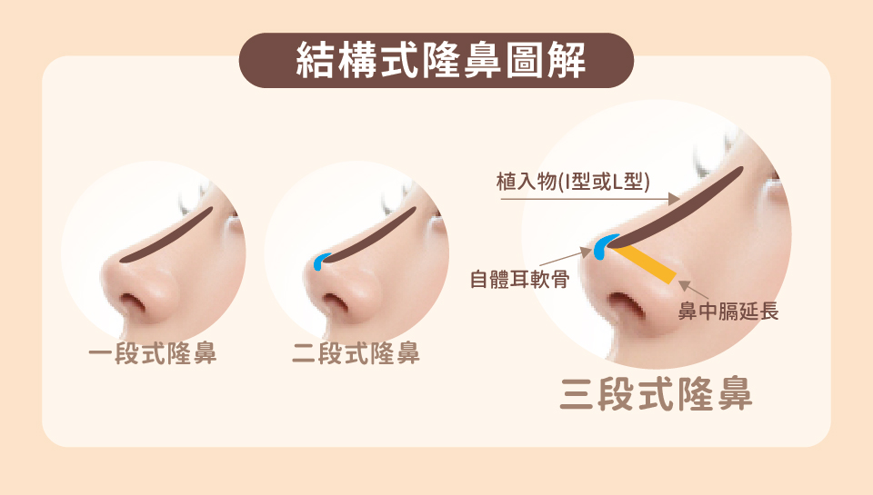 結構式隆鼻解剖結構圖 - 顯示鼻部各個結構組成與手術重點