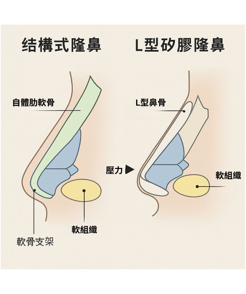 結構式隆鼻詳細圖解